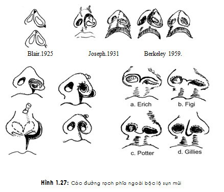 Đường rạch phía ngoài trong chỉnh sửa cấu trúc mũi