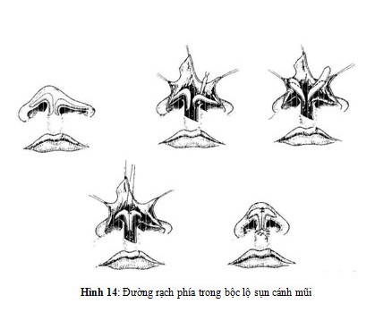 Đường rạch phía trong và kỹ thuật treo sụn cánh mũi