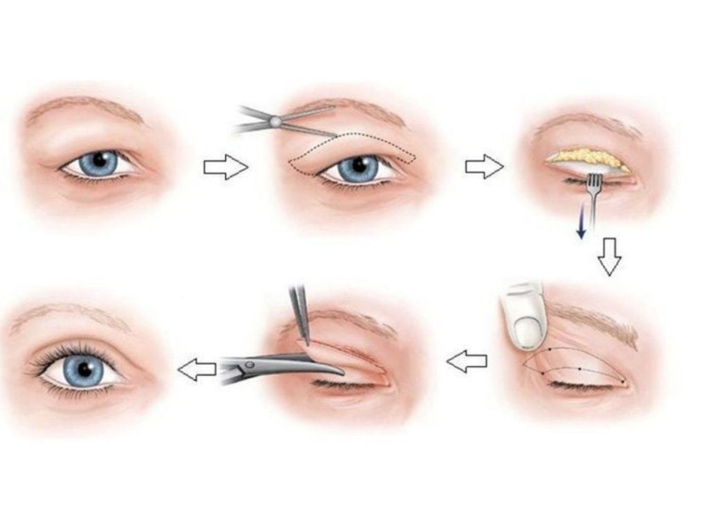 Quy trình cắt da thừa mí mắt