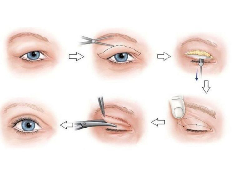 Quy trình cắt da thừa mí mắt