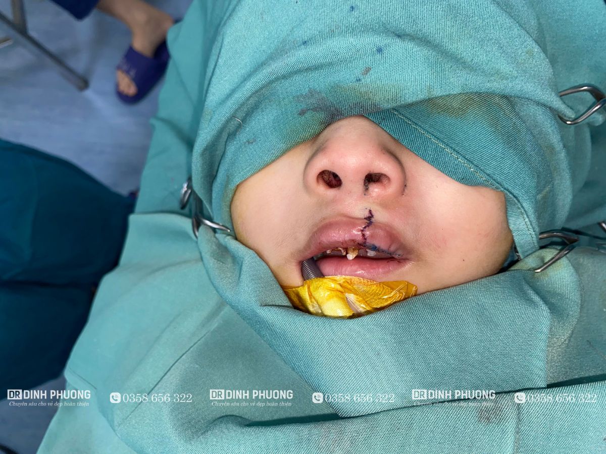 Giải pháp tạo hình thẩm mỹ mũi bị biến dạng