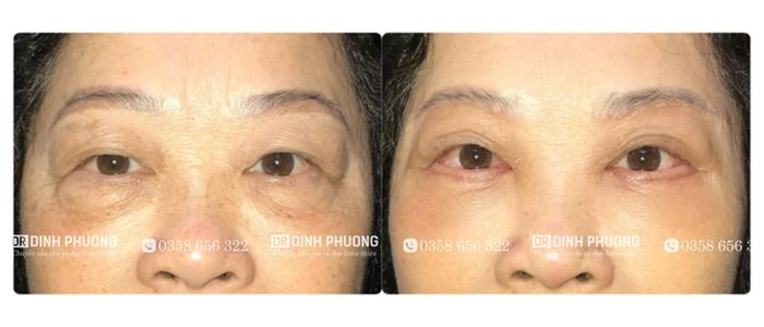 Hình ảnh trước và sau khi cắt da thừa mí mắt tại bác sĩ Trần Đình Phượng