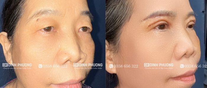 Hình ảnh trước và sau khi cắt da thừa mí mắt tại bác sĩ Trần Đình Phượng