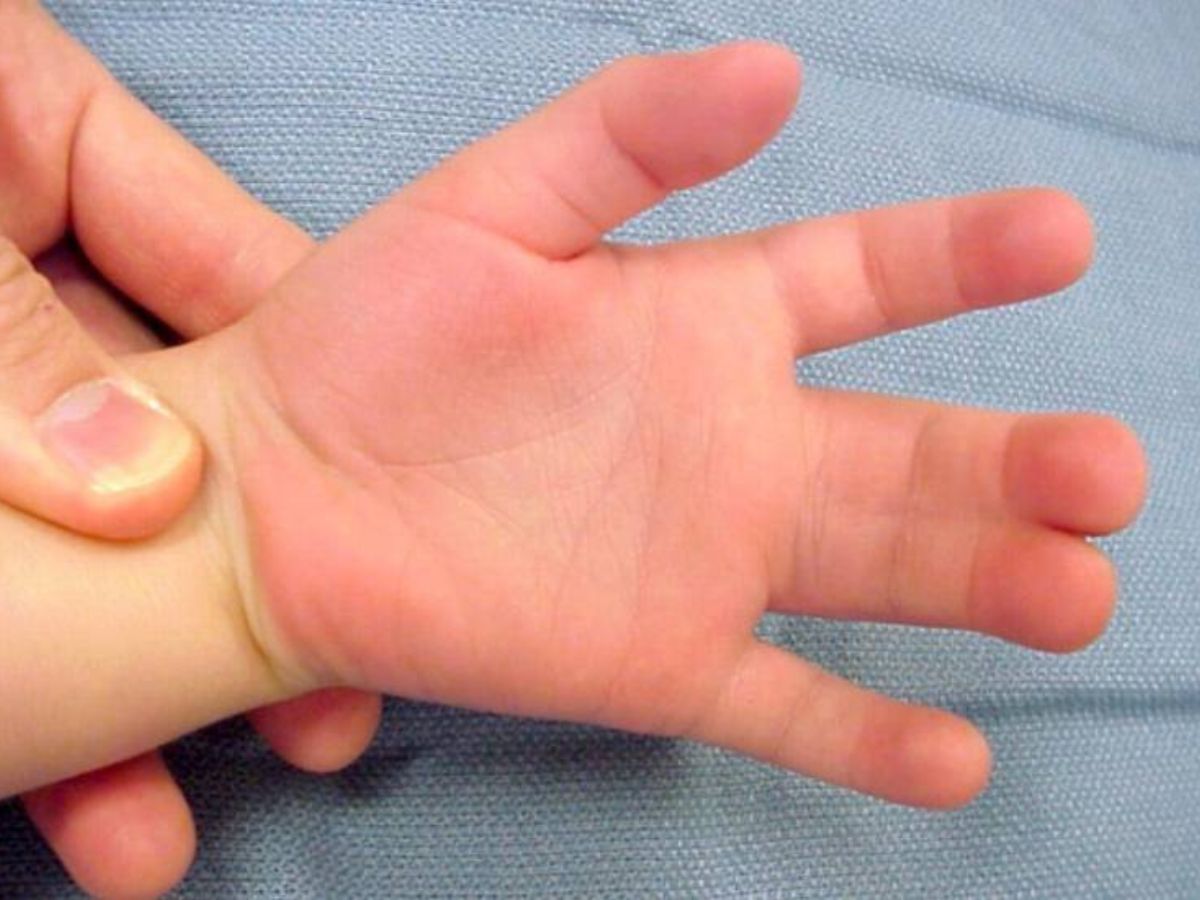 Hình ảnh dị tật dính ngón tay