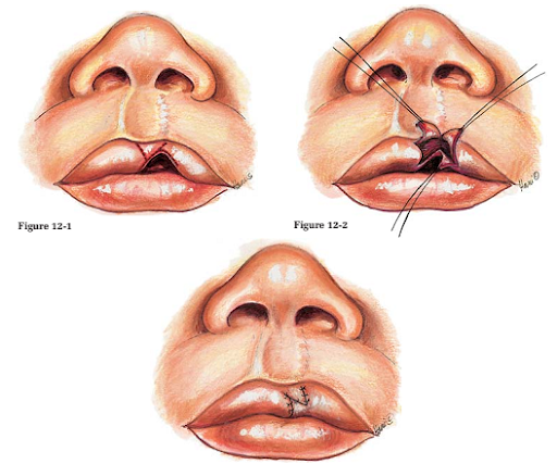 Phương pháp tạo hình thẩm mỹ môi - tạo hình vạt chữ Z