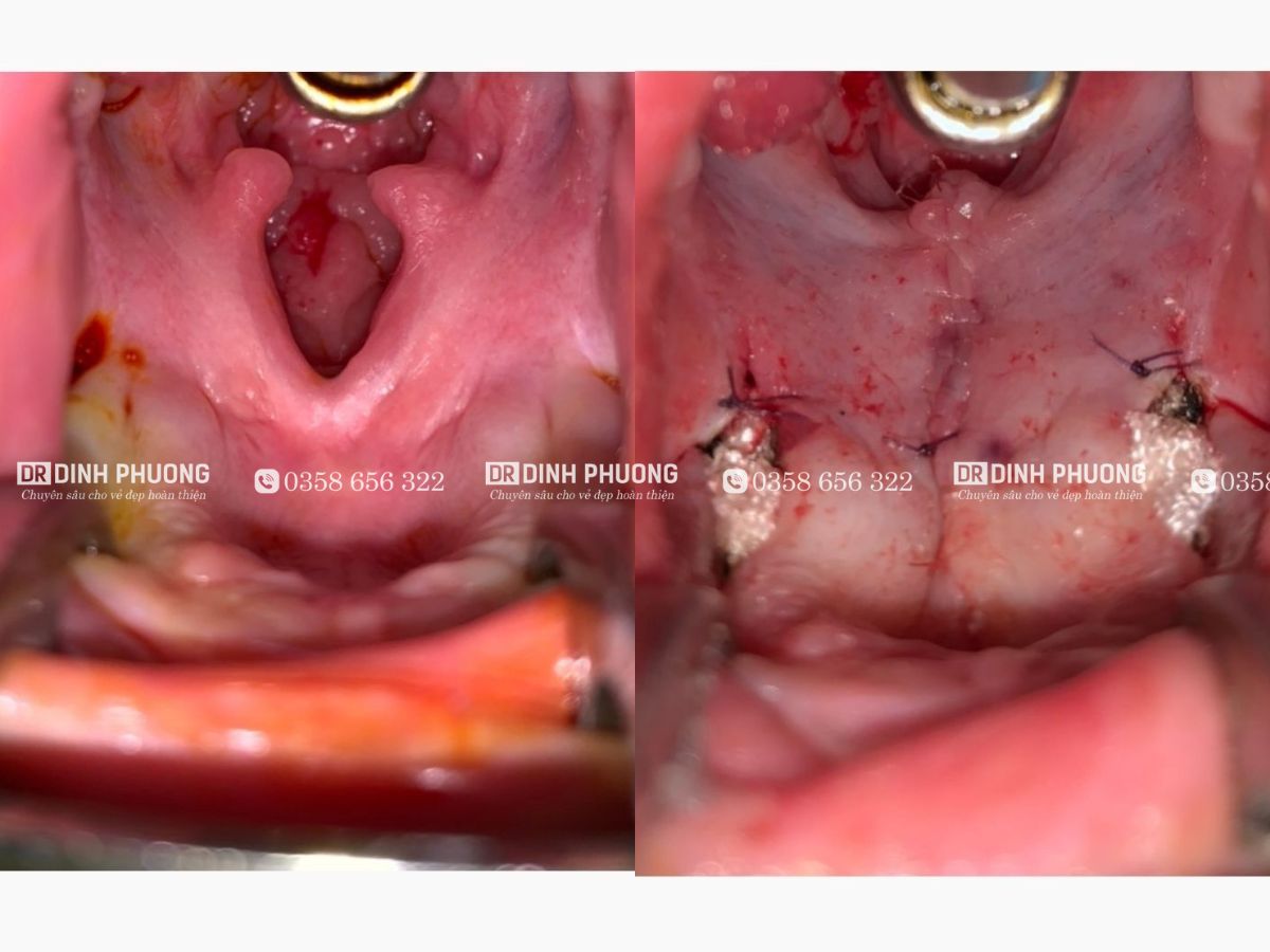 Hình ảnh trước và sau khi phẫu thuật khe hở vòm bằng Kỹ thuật Von Langenbeck