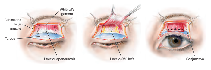 Phương pháp tịnh tiến điểm bám của cơ nâng mi