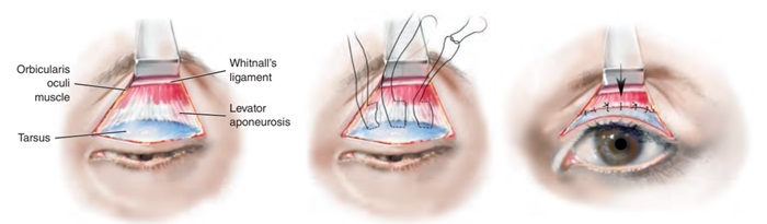 Phương pháp thu ngắn cơ nâng mi