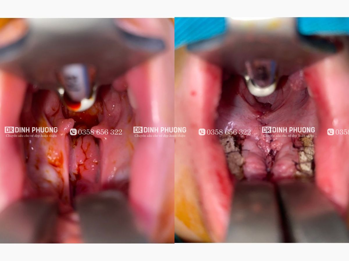 Hình ảnh trước và sau khi phẫu thuật khe hở vòm bằng kỹ thuật đường chữ Z