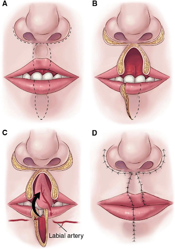 Phương pháp tạo hình thẩm mỹ môi - sử dụng vạt Abbe