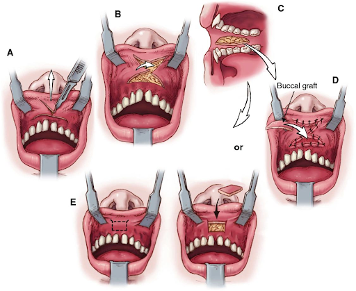 Phương pháp tạo hình thẩm mỹ môi - Kỹ thuật tạo hình vạt tại chỗ