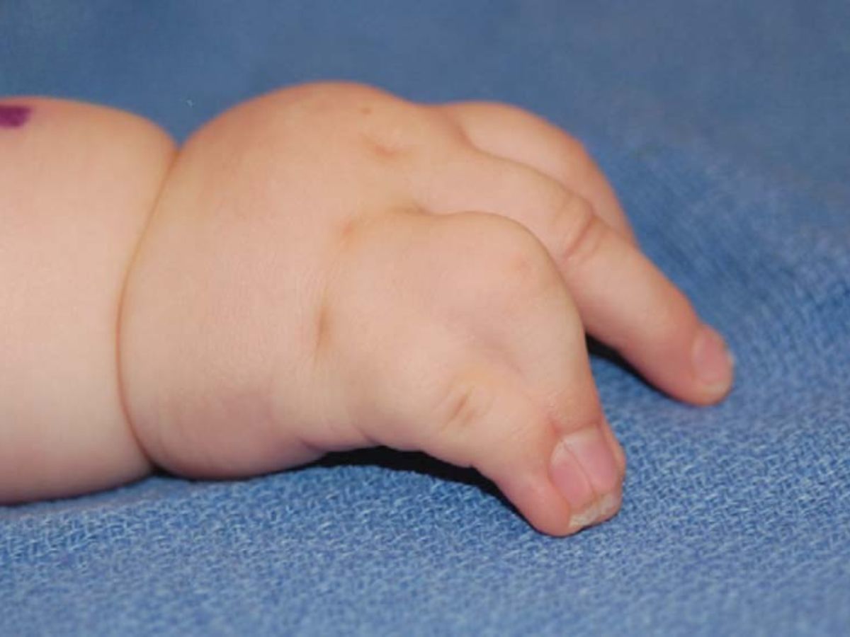 Những ảnh hưởng của dị tật dính ngón tay là gì?