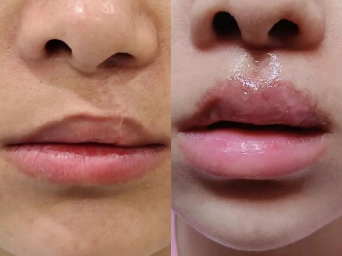 Những câu hỏi thường gặp khi tạo hình môi