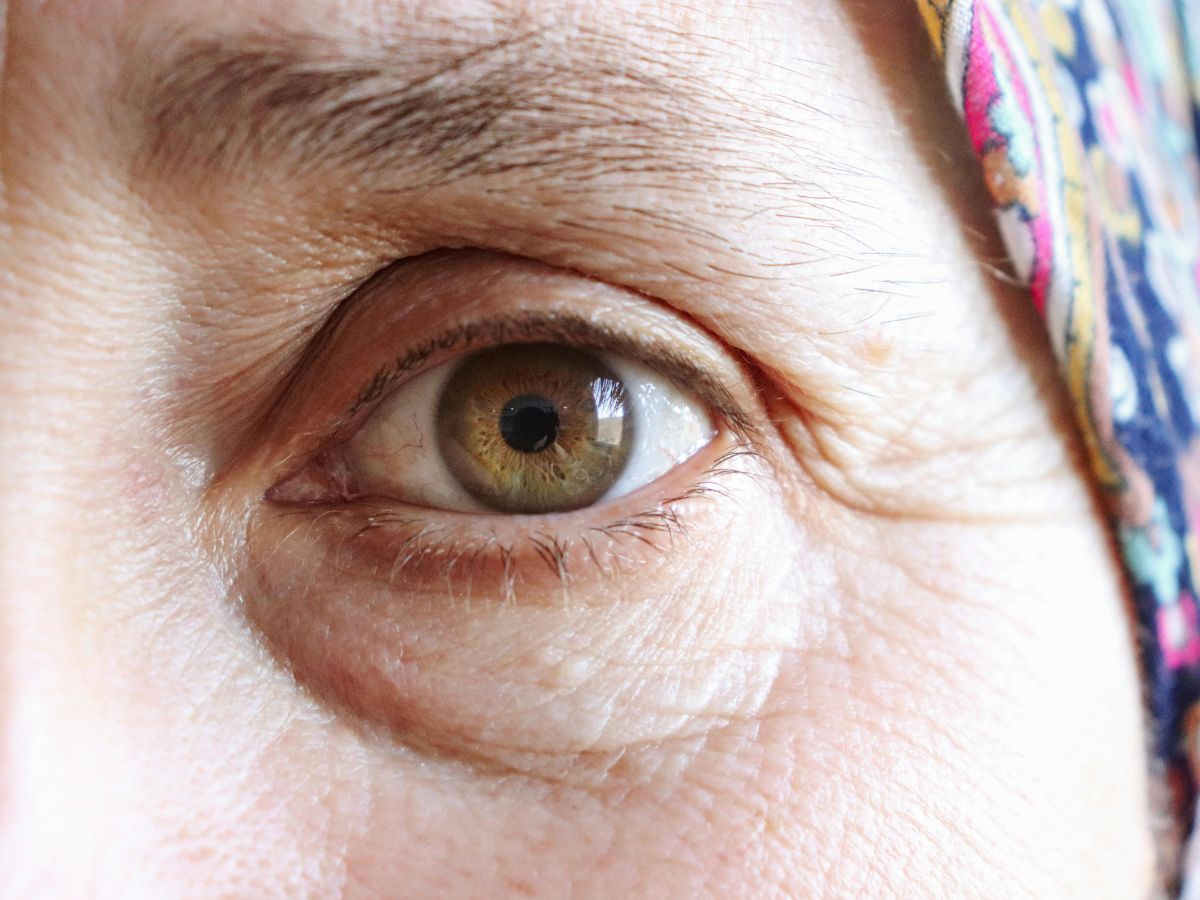 Những dấu hiệu da thừa mi mắt dễ nhận biết