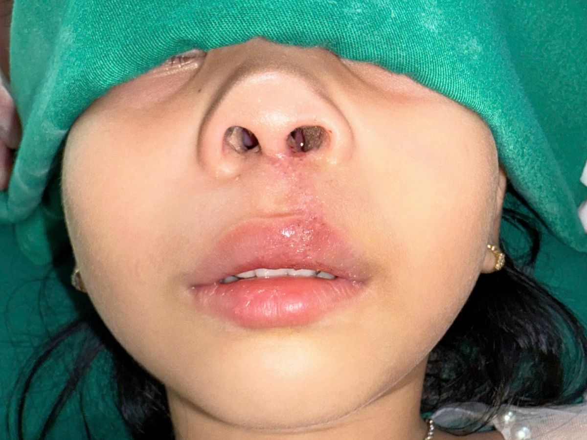 Những lưu ý khi thực hiện tạo hình thẩm mỹ mũi 