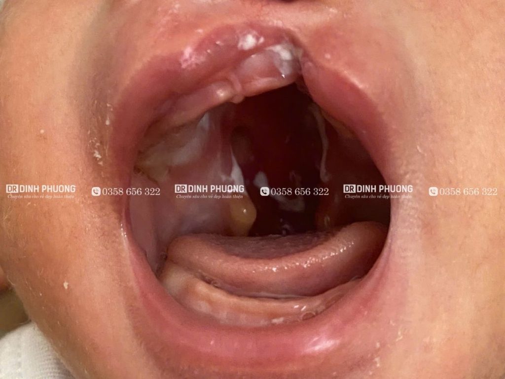 Khe hở vòm là gì? Tại sao cần phẫu thuật khe hở vòm sớm cho trẻ?