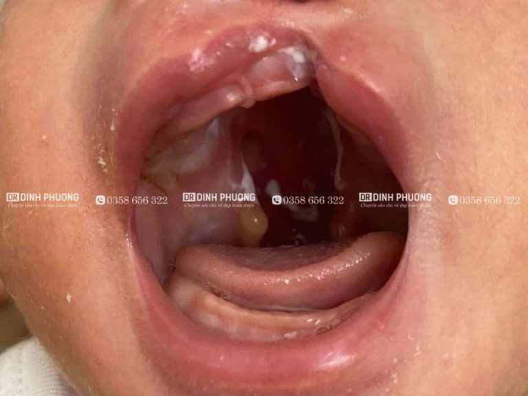 Khe hở vòm là gì? Tại sao cần phẫu thuật khe hở vòm sớm cho trẻ?