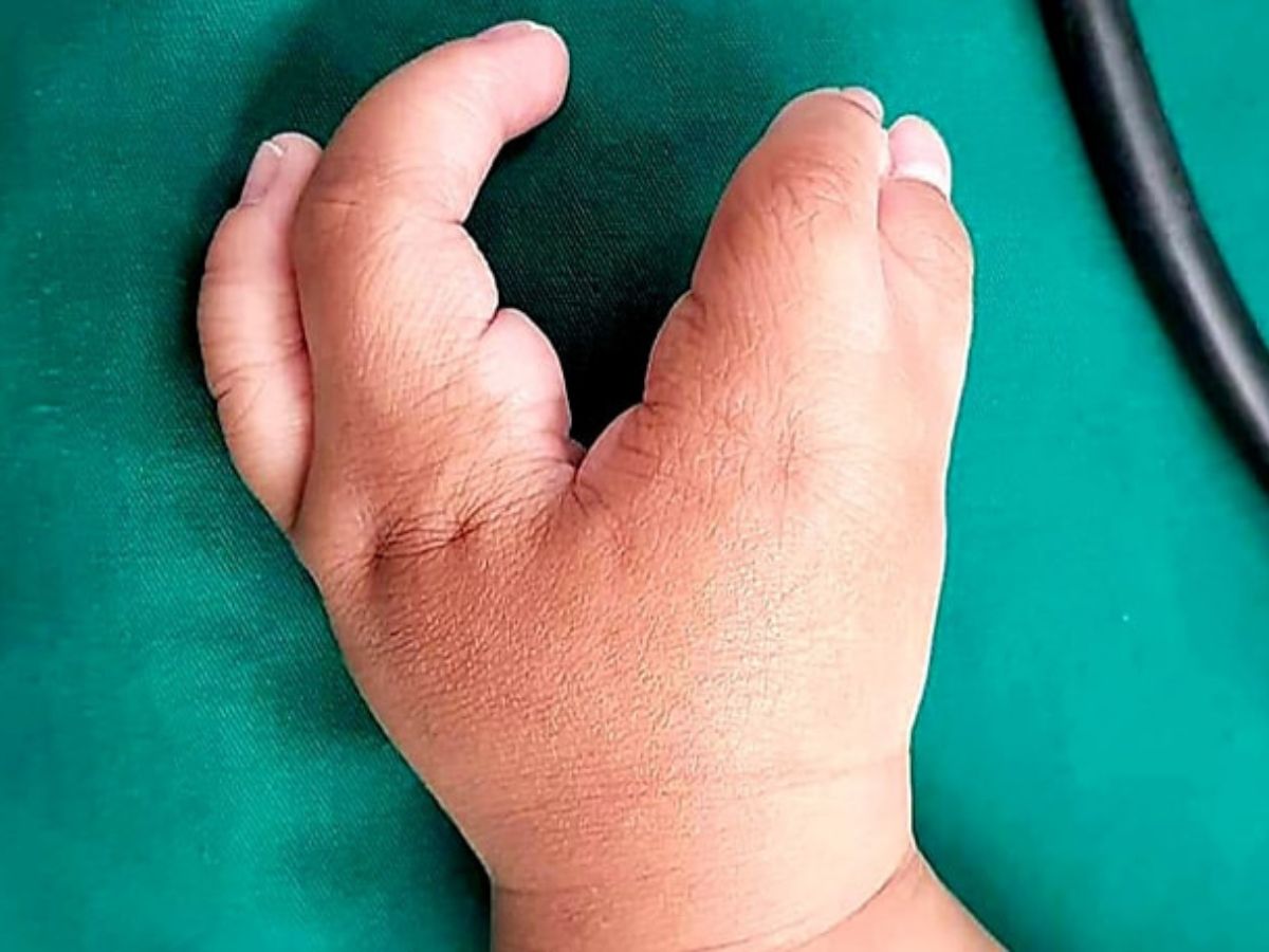 Phân loại dị tật dính ngón tay theo từng mức độ