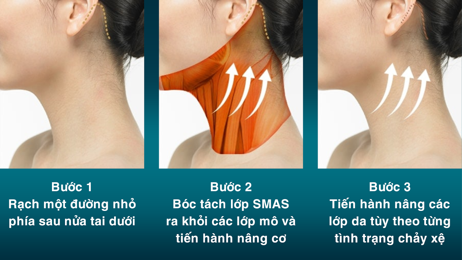 Phương pháp phẫu thuật căng da trẻ hóa vùng cổ