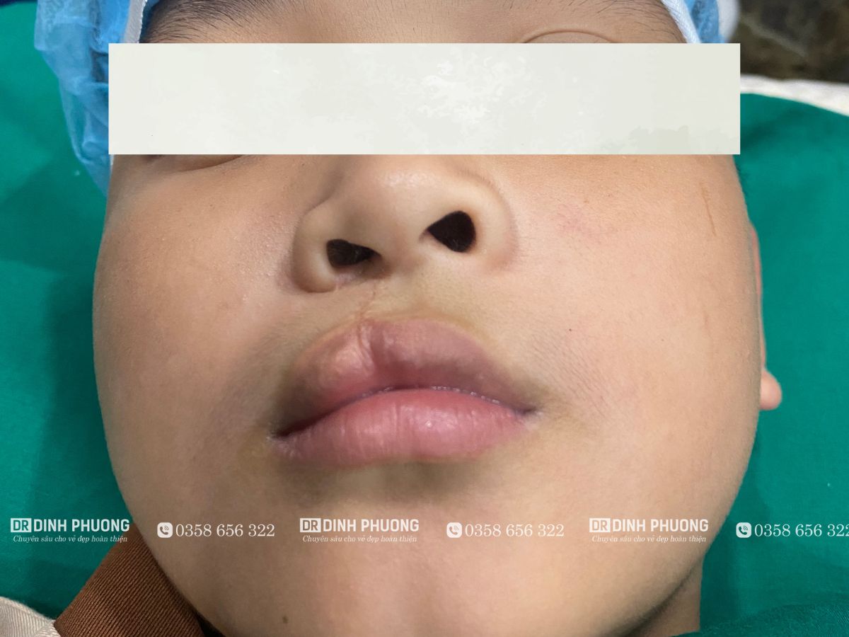 Tại sao cần tạo hình thẩm mỹ môi sau phẫu thuật khe hở môi