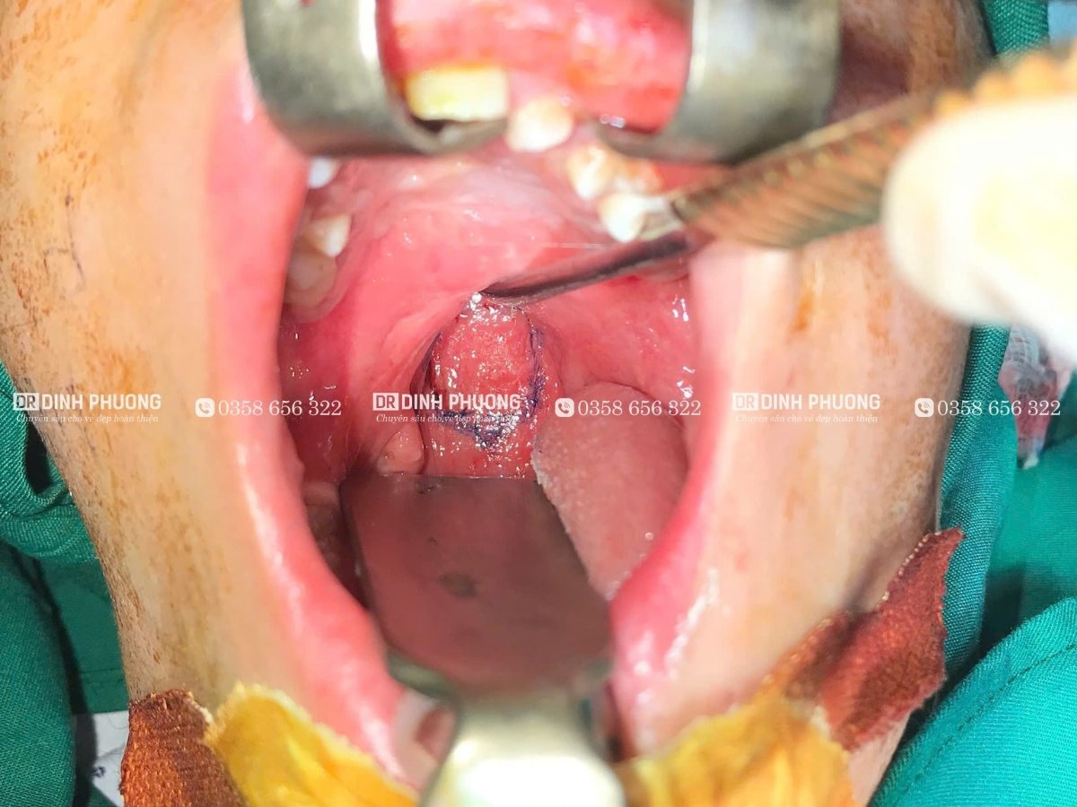 Khe hở vòm ở trẻ sơ sinh