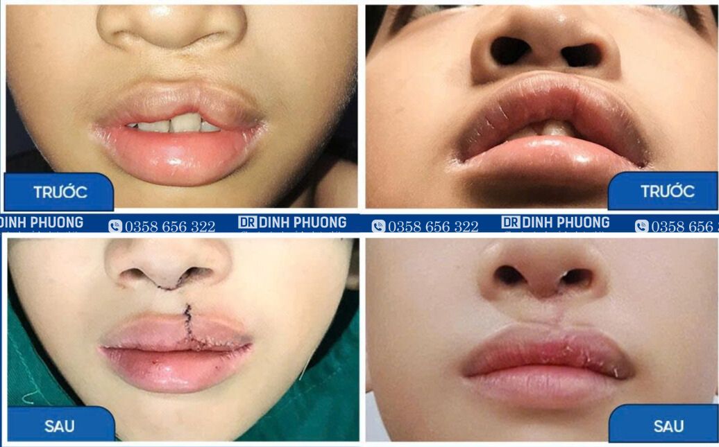 1-Hình ảnh trước - sau phẫu thuật tạo hình thẩm mỹ môi