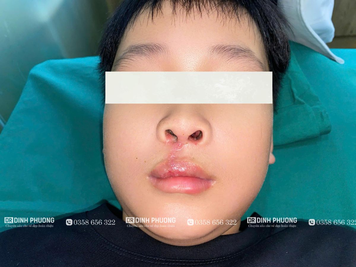 Tạo hình thẩm mỹ môi là gì