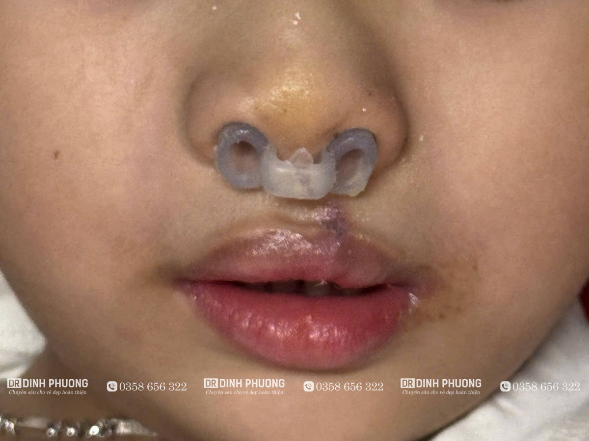 Tạo hình thẩm mỹ mũi bị biến dạng sau phẫu thuật môi là gì?