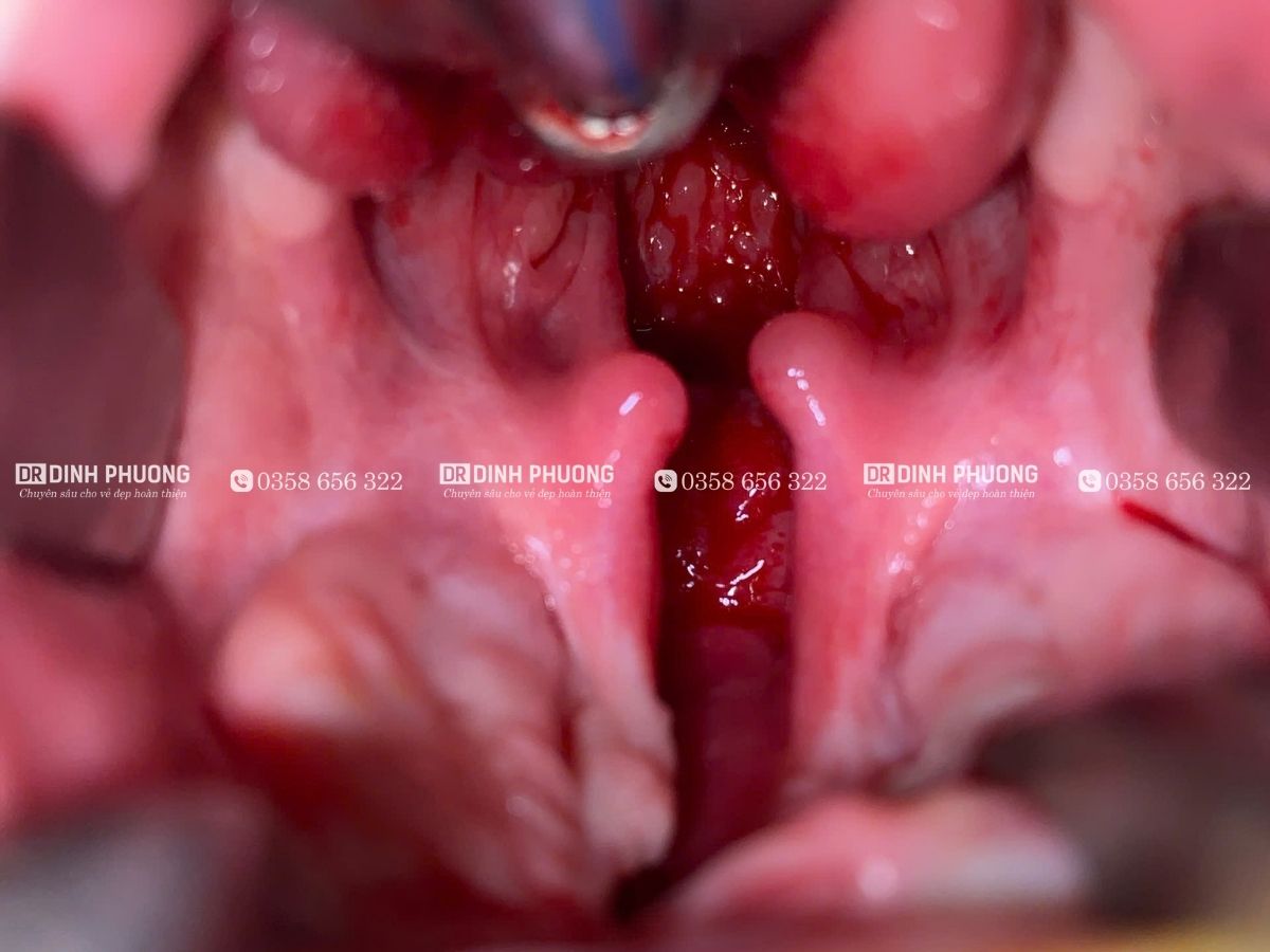 Thời điểm và phương pháp phẫu thuật khe hở vòm hiện nay