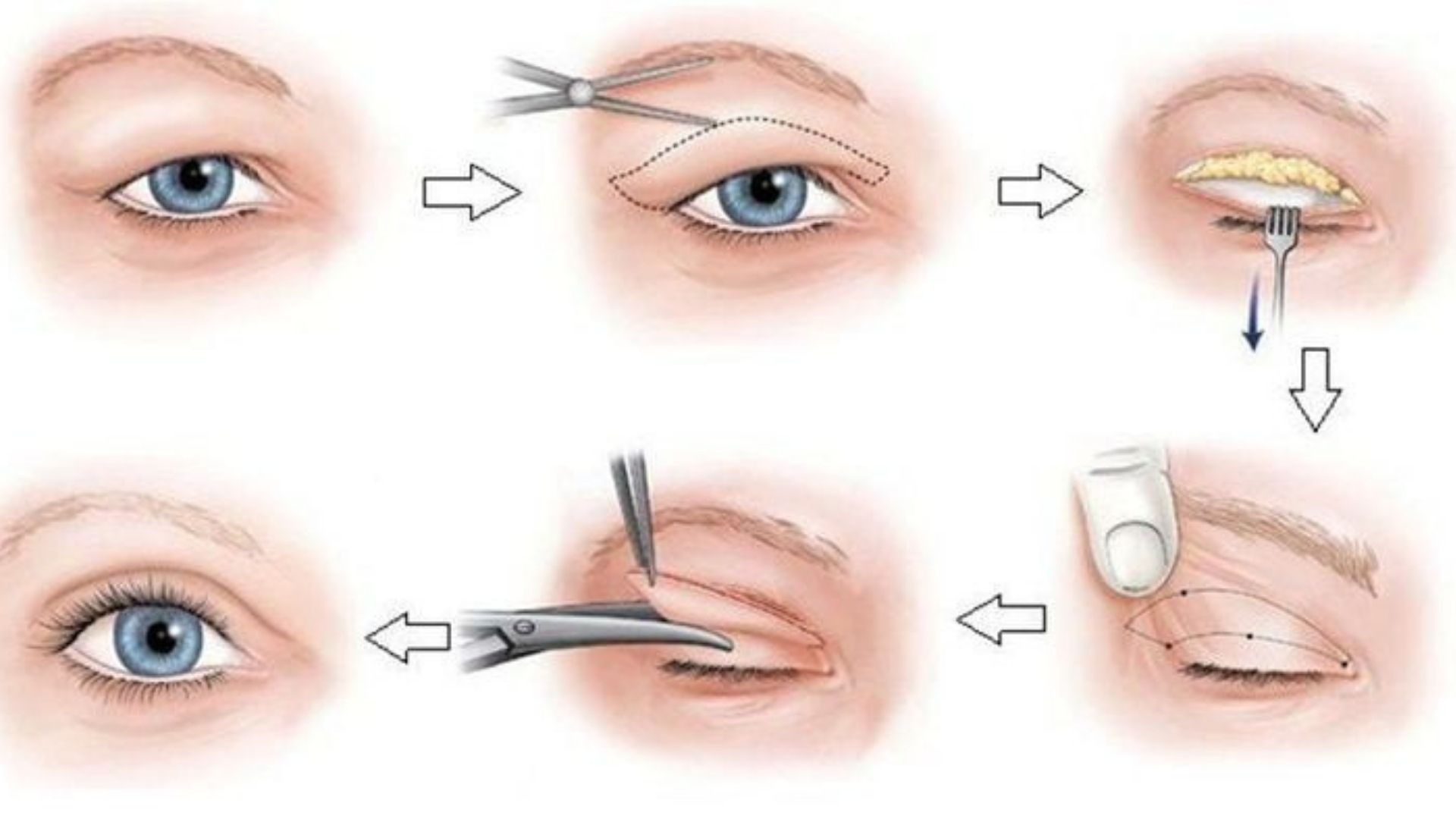 Quy trình và lưu ý khi cắt da thừa mi mắt