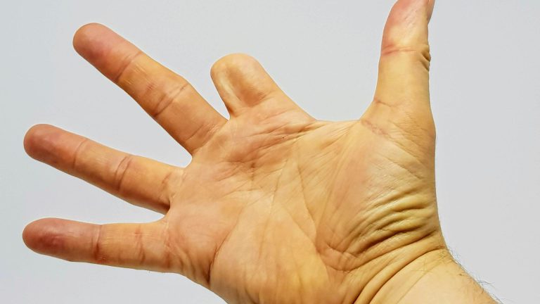 Dị tật thiếu ngón tay