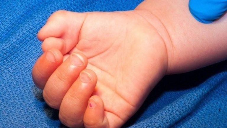 Dị tật thừa ngón tay