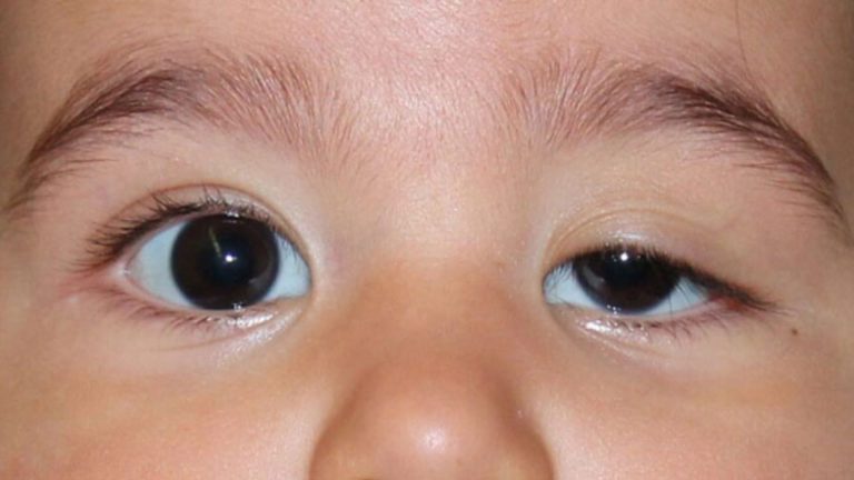 Hình ảnh sụp mí mắt