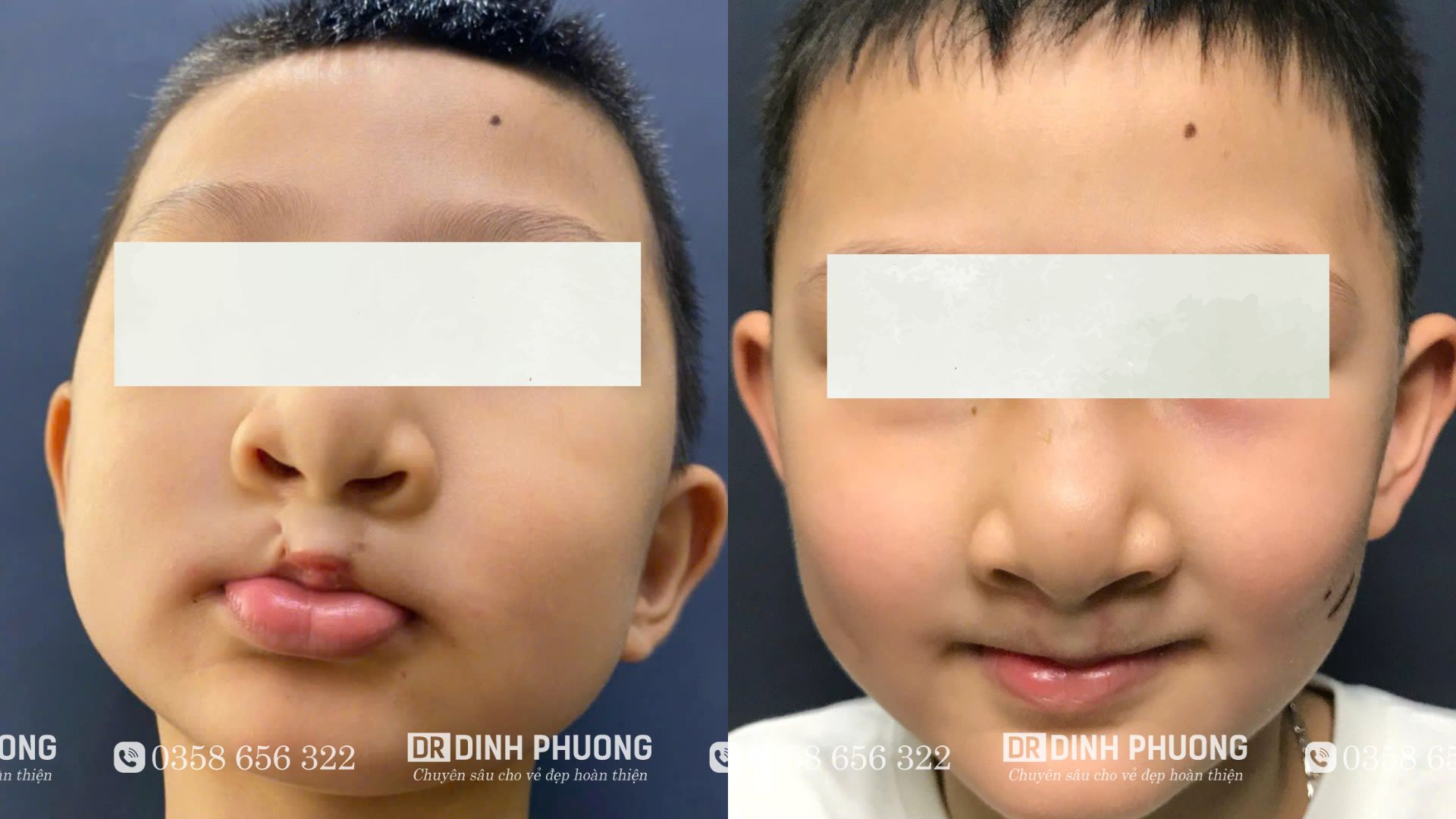 Hình ảnh trước - sau phẫu thuật tạo hình thẩm mỹ môi