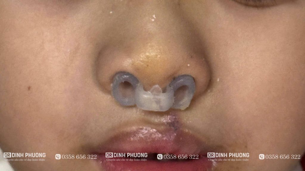 Tạo hình thẩm mỹ mũi bị biến dạng sau phẫu thuật khe hở môi