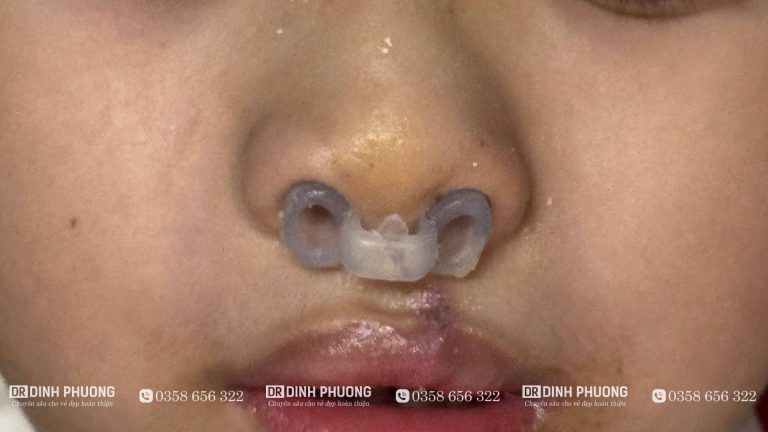 Tạo hình thẩm mỹ mũi bị biến dạng sau phẫu thuật khe hở môi