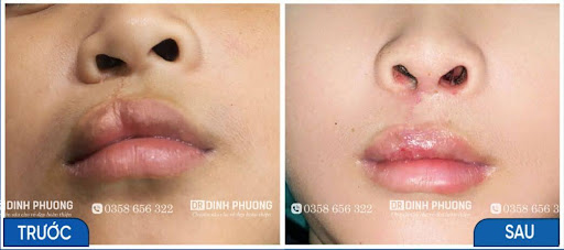 3-Hình ảnh trước - sau phẫu thuật tạo hình thẩm mỹ môi