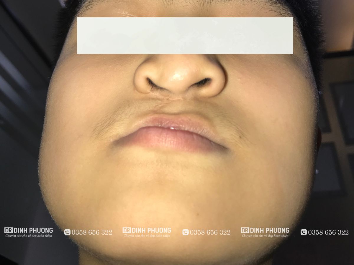 Mũi có thể bị biến dạng sau khi phẫu thuật khe hở môi?