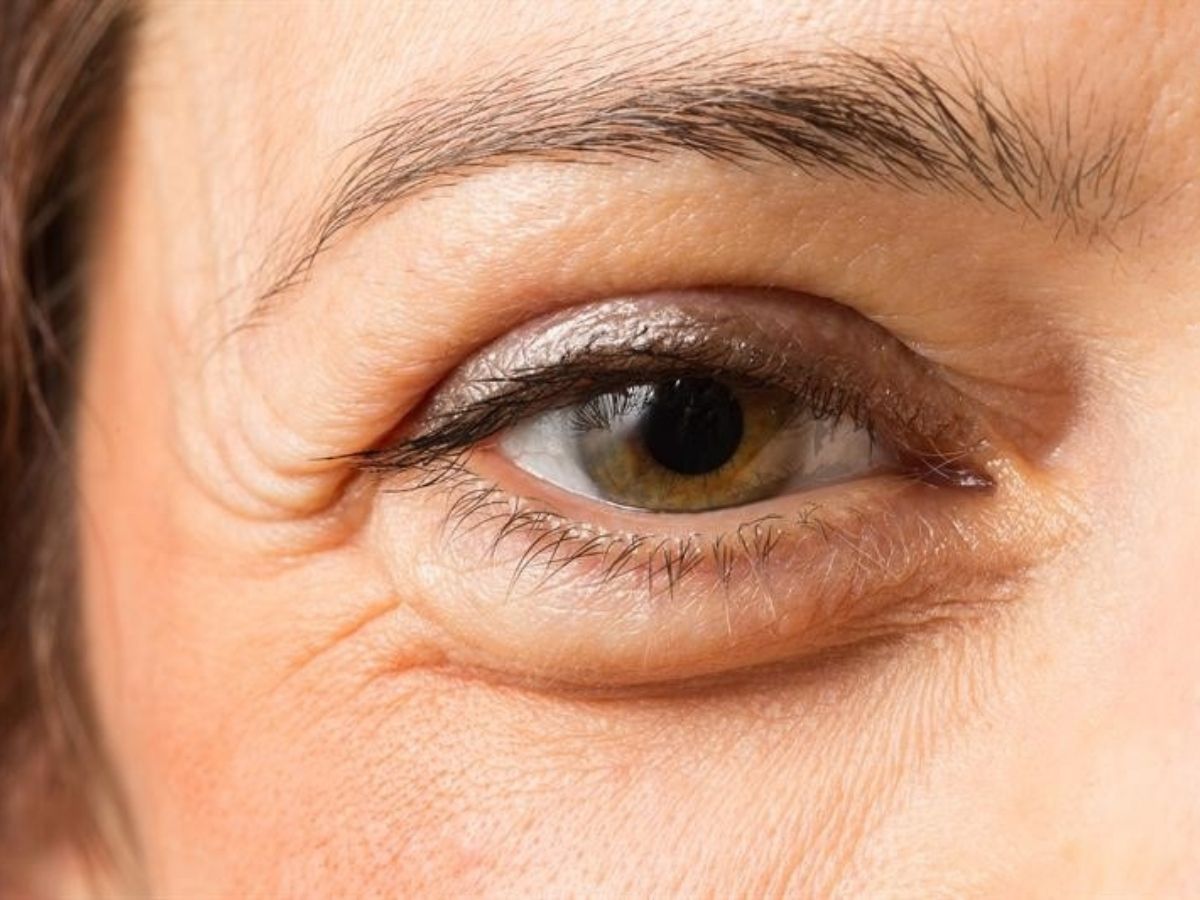 Lợi ích khi cắt da thừa mi mắt