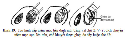 Xử lý phần mềm và niêm mạc tiền đình mũi đi kèm
