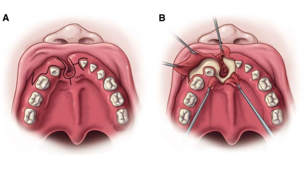 Phẫu thuật điều trị khe hở xương hàm trên