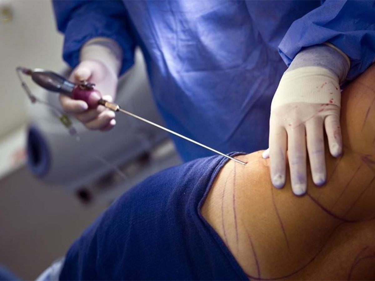 Tổng quan về phương pháp thẩm mỹ hút mỡ bụng 