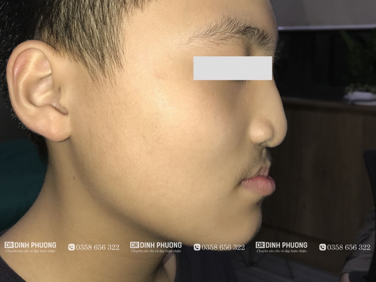 Hình ảnh bệnh nhân thiểu sản xương hàm trên