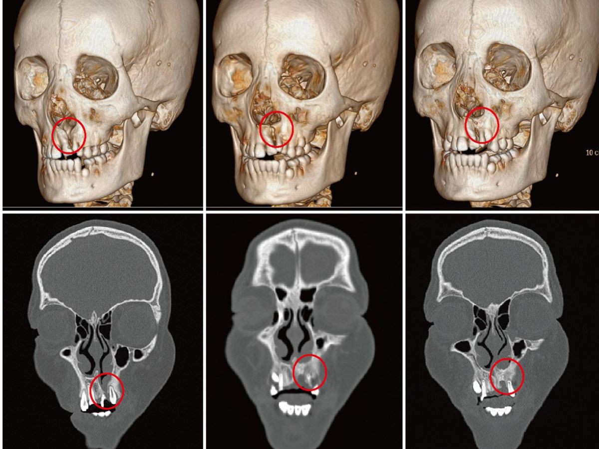 Hình ảnh panorama của người bị hở khe xương hàm trên