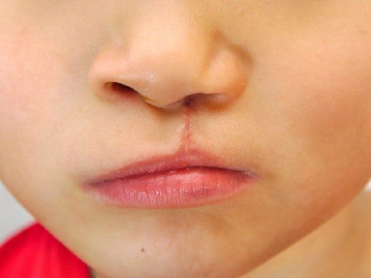 Di tật khe hở vòm môi là một trong những nguyên gây thiểu sản xương hàm trên 