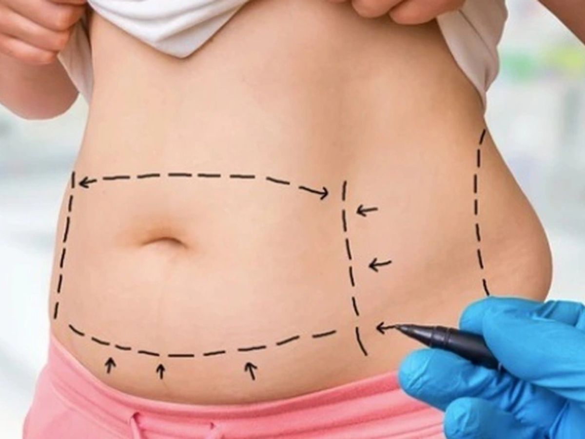 Hút mỡ bụng đạt hiệu quả cao với người có chỉ số BMI bình thường hoặc hơi thừa cân 