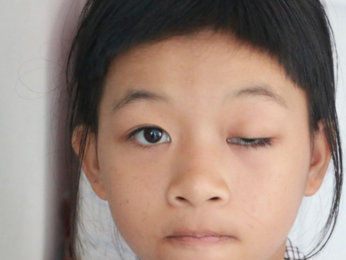 Phân loại mức độ sụp mí mắt bẩm sinh 