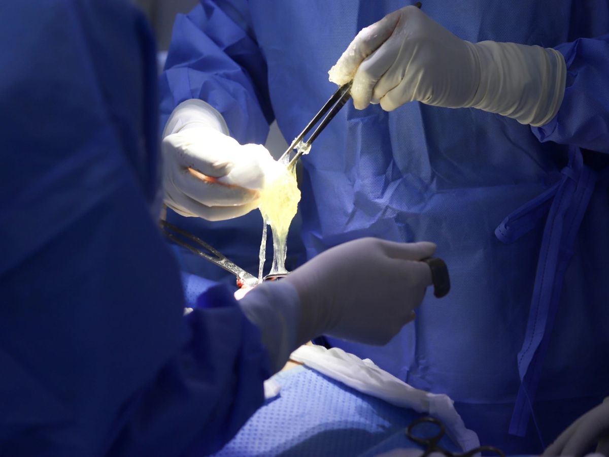 Bạn nên thực hiện tháo túi ngực khi túi bị vỡ hoặc rò rỉ 