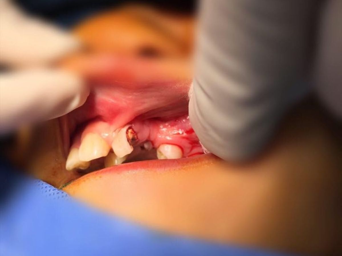 Hình ảnh bệnh nhân bị khe hở xương hàm trên