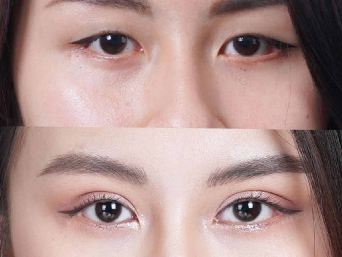 Ưu và nhược điểm phương pháp thẩm mỹ nhấn mí mắt